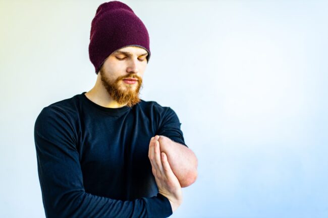 image of amputee with phantom limb pain